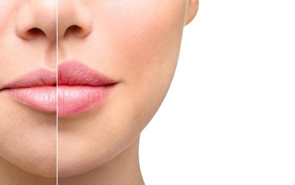تزریق ژل دکتر رضا کریمیان 04