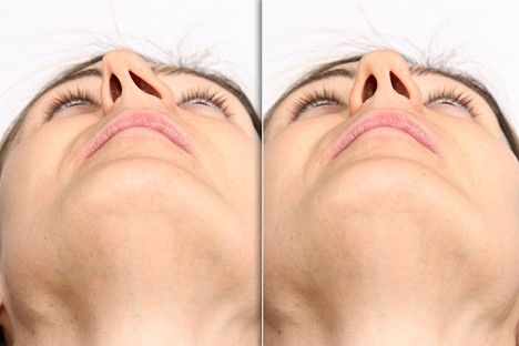 سپتورینوپلاستی برای رفع انحراف بینی