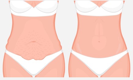 اصلاح افتادگی شکم در جراحی زیبایی