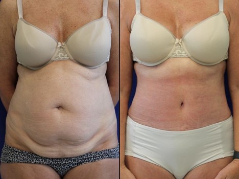 تغییر یک بیمار پس از جراحی زیبایی شکم به‌روش کامل