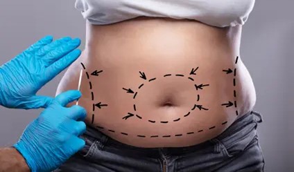 مناطقی برای ایجاد برش در ابدومینوپلاستی