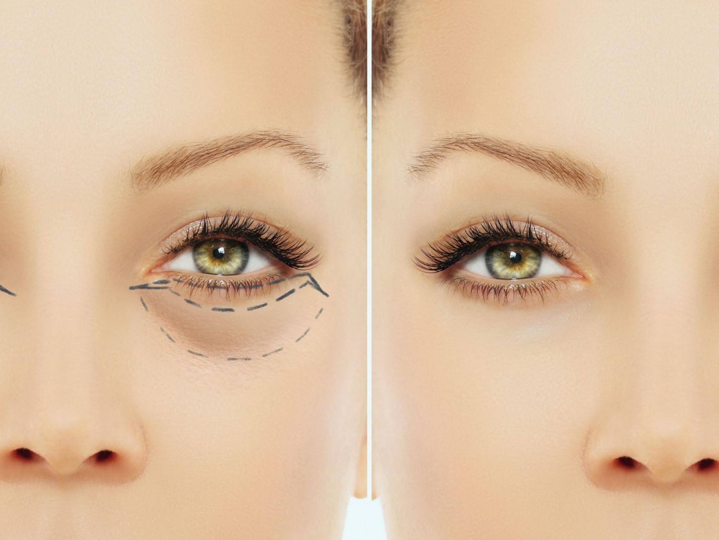 بهبود چروک زیر چشم با عمل بلفاروپلاستی پلک پایین