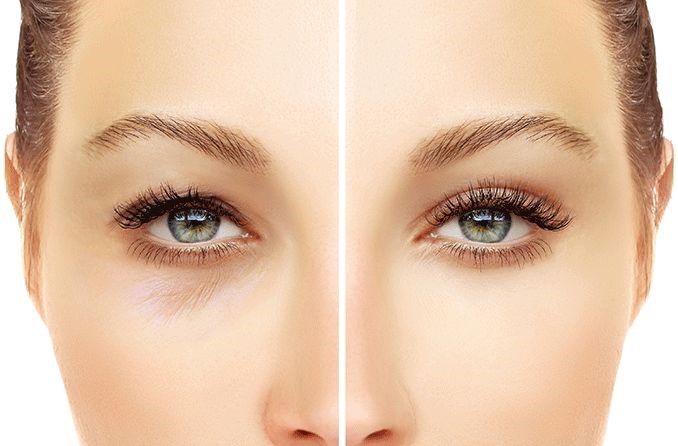 قبل و بعد از جراحی پلک پایین