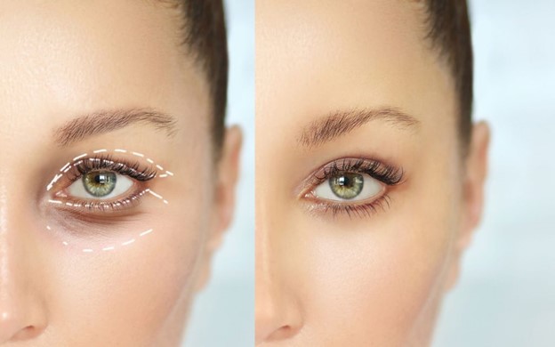 عوارض و خطرات جراحی بلفاروپلاستی