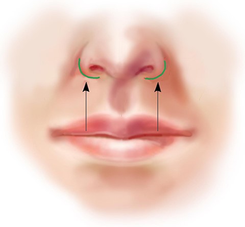 مراقبت‌های پیش از جراحی سانترال لب