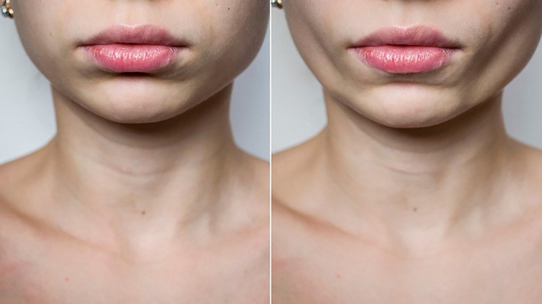 بعد از تخلیه بوکال صورت باید مراقبت‌ها جدی گرفته شوند