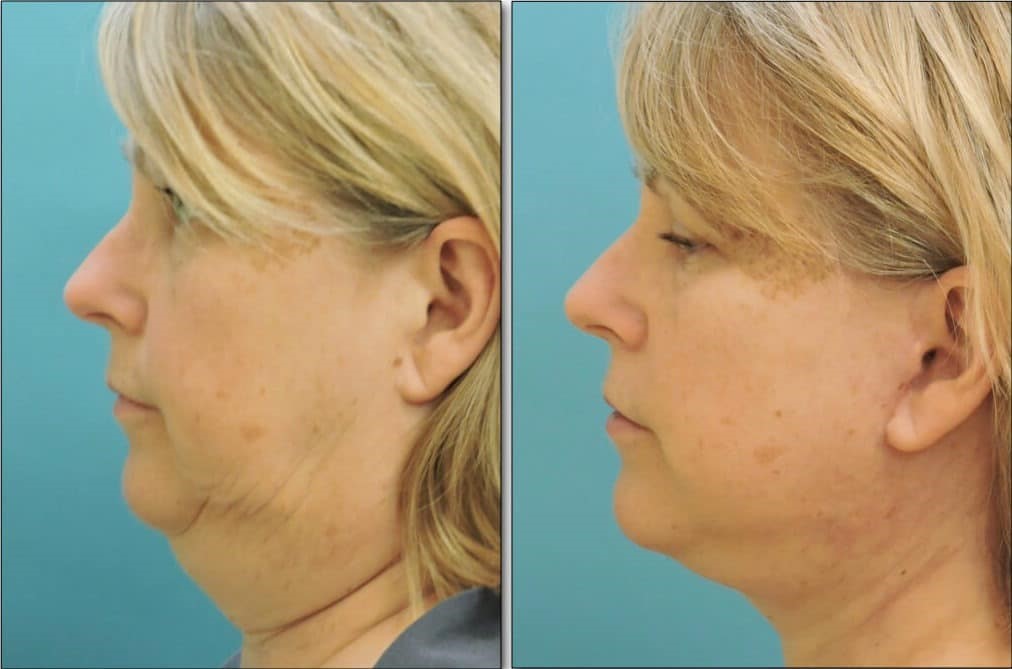 ساکشن غبغب و تخلیه چربی‌ها از این ناحیه بدن