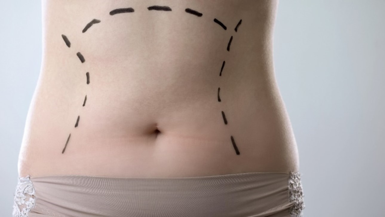 نحوه انجام لیپوساکشن شکم و پهلو