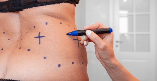 جراحی لیپوساکشن برای شکم و پهلو