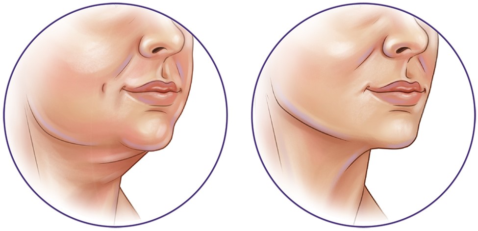 لیپوساکشن غبغب چیست و چگونه انجام میشود؟