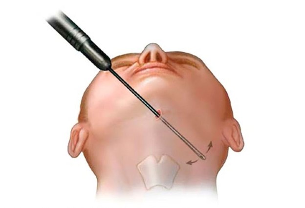 لیپوساکشن رفع غبغب چگونه انجام می‌شود؟