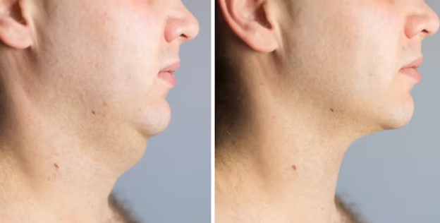 مزایای لیپوساکشن غبغب کدامند؟