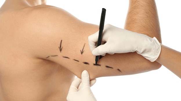 جراحی لیپوساکشن بازو چگونه انجام می‌شود؟