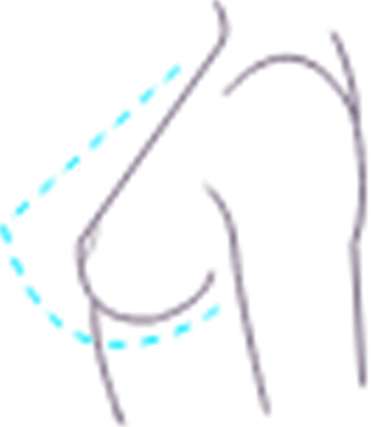 عمل پروتز سینه