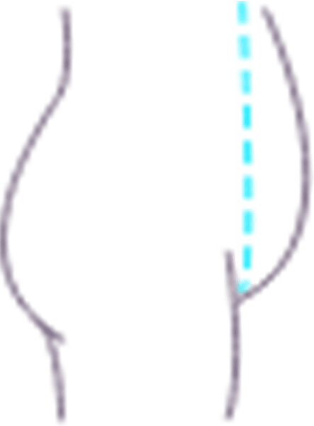 عمل ابدومینوپلاستی