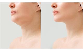 عمل لیپوساکشن غبغب چیست؟