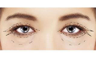 بلفاروپلاستی ترکیبی پلک بالا و پایین