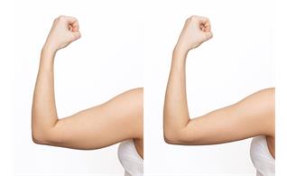 لیپوساکشن بازو چیست