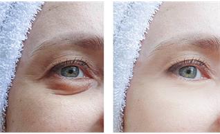 بلفاروپلاستی پلک پایین