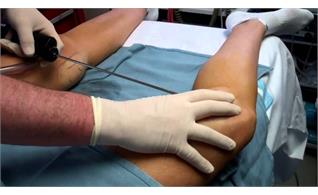 عمل لیپوساکشن