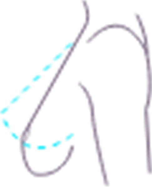 ماموپلاستی